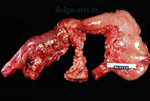 Воспаление поджелудочной железы. Воспаление жизненно важной железы — не такая уж и редкость