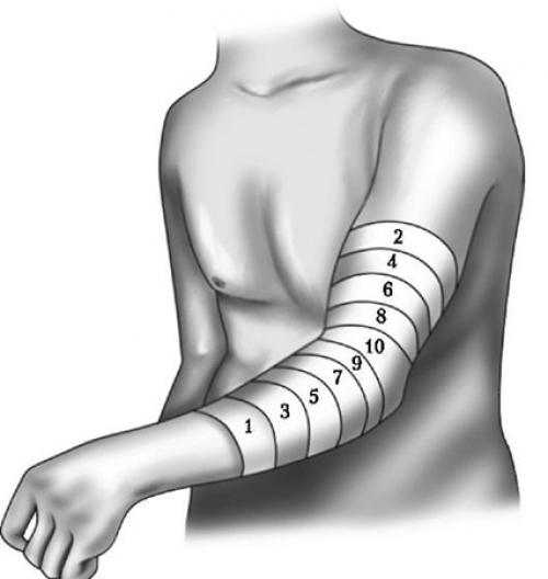 Расходящаяся черепашья повязка на коленный сустав. Черепашья повязка на коленный сустав