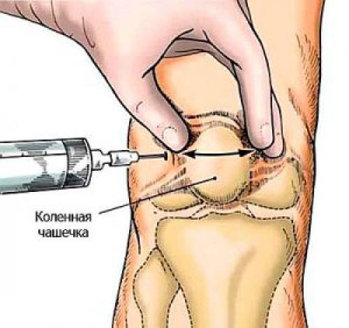Боль после укола в колено. Уколы в колено при артрозе
