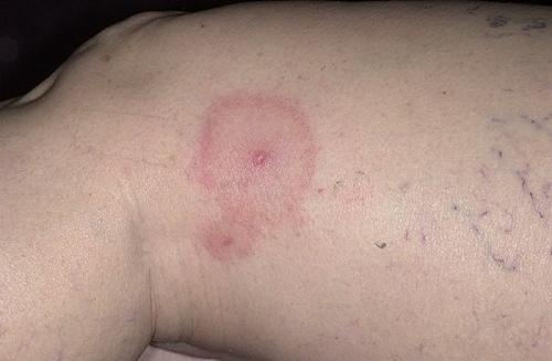 На плече увеличился лимфоузел. Лимфаденопатия (увеличение лимфоузлов)