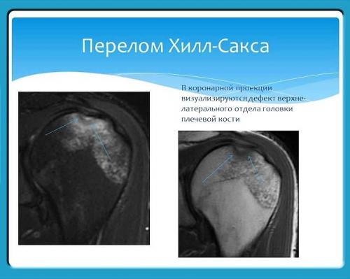 Повреждение Хилл-Сакса плечевого сустава, что это. Классификация