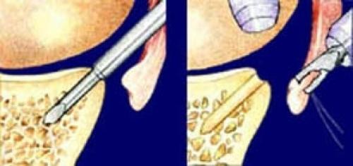 Повреждение Хилл-Сакса. Восстановление при повреждениях Хилла-Сакса 10 Повреждение Хилл-Сакса. Восстановление при повреждениях Хилла-Сакса 10