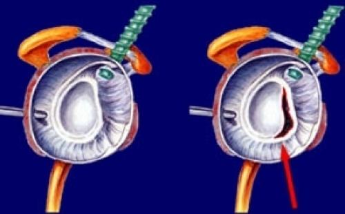 Повреждение Хилл-Сакса. Восстановление при повреждениях Хилла-Сакса 08 Повреждение Хилл-Сакса. Восстановление при повреждениях Хилла-Сакса 08