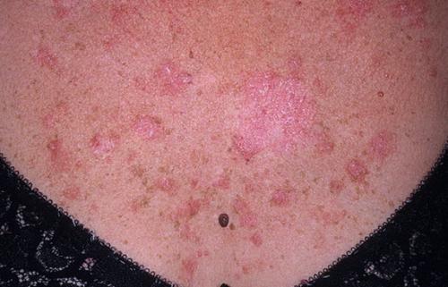 На плече увеличился лимфоузел. Лимфаденопатия (увеличение лимфоузлов)