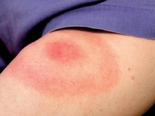 На плече увеличился лимфоузел. Лимфаденопатия (увеличение лимфоузлов)