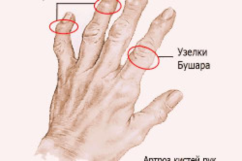 Шишка на пальце руки на суставе. Шишки на пальцах рук 02