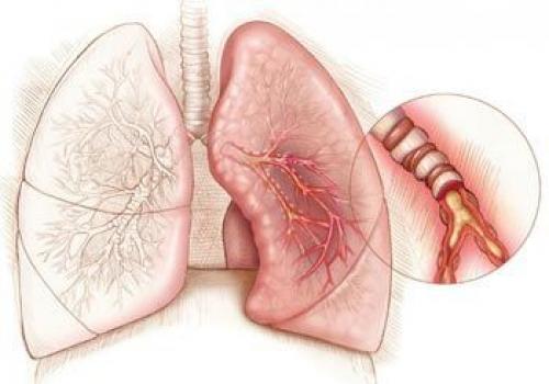Основная жалоба больных с застарелым повреждением мениска. Виды травм менисков 03 Основная жалоба больных с застарелым повреждением мениска. Виды травм менисков 03
