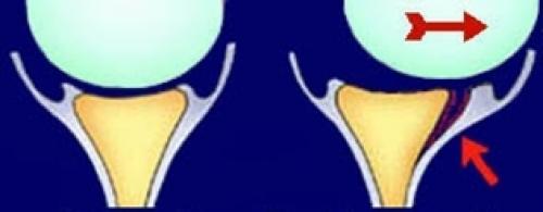 Повреждение Хилл-Сакса. Восстановление при повреждениях Хилла-Сакса 07 Повреждение Хилл-Сакса. Восстановление при повреждениях Хилла-Сакса 07