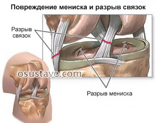 Пкс коленного сустава. Характерные симптомы