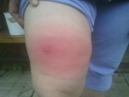 Опухло колено, но не болит. Колено опухло, но не болит: причины, что это может быть, диагностика и лечение