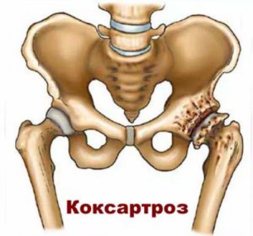 Тазобедренный сустав Фото рентгена здорового и больного человека с описанием. Строение и патологии +Видео