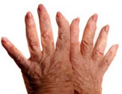 Проксимальный межфаланговый сустав 1 пальца стопы. Межфаланговый сустав