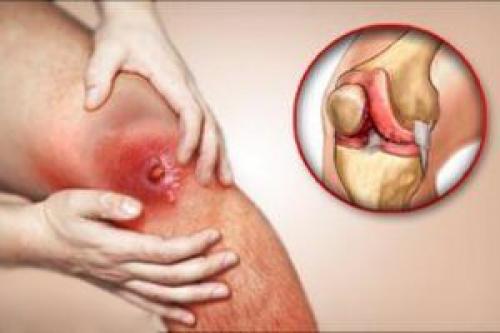 Проксимальный межфаланговый сустав 1 пальца стопы. Межфаланговый сустав