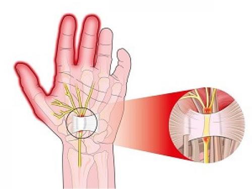 Немеет левая рука лекарство. Немеет левая рука, кисть