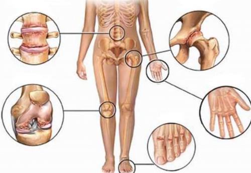 Деформирующий остеоартроз тазобедренного сустава мкб-10. Разделение недуга по суставам