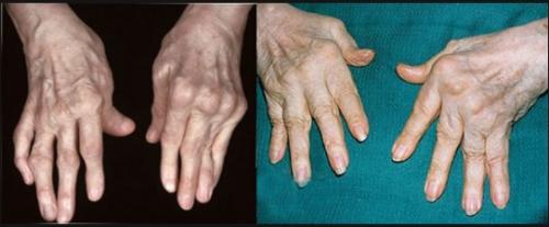 Деформирующий остеоартроз тазобедренного сустава мкб-10. Разделение недуга по суставам