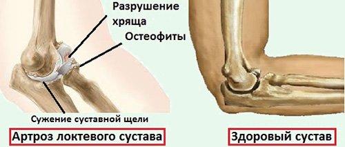 Код по мкб артроз локтевого сустава. Общая характеристика