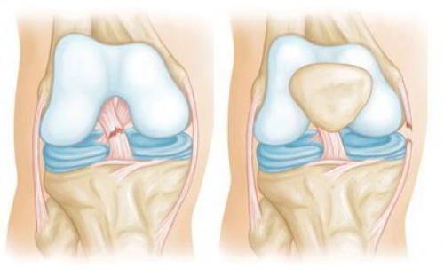 Сколько по времени заживает разрыв связок коленного сустава. Причины разрыва связок колена 05