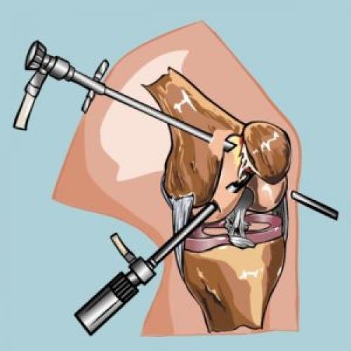 Повреждение заднего рога внутреннего мениска 3а степени по stoller. Симптомы повреждения мениска 03