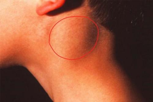 Боль в лимфоузлах на шее. Причины и лечение болей в лимфоузлах на шее