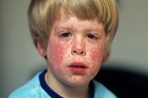 Боль в лимфоузлах на шее. Причины и лечение болей в лимфоузлах на шее