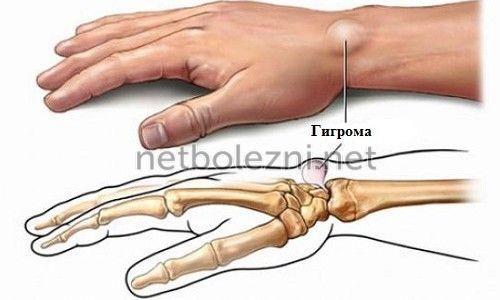 Косточки растут на руках. Народная медицина 05
