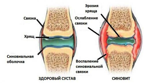 После пива болят суставы. Могут ли после алкоголя болеть суставы?