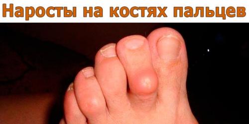 На косточках пальцев рук шишки. Шишки на суставах пальцев рук: причины, симптомы и лечение 01 На косточках пальцев рук шишки. Шишки на суставах пальцев рук: причины, симптомы и лечение 01