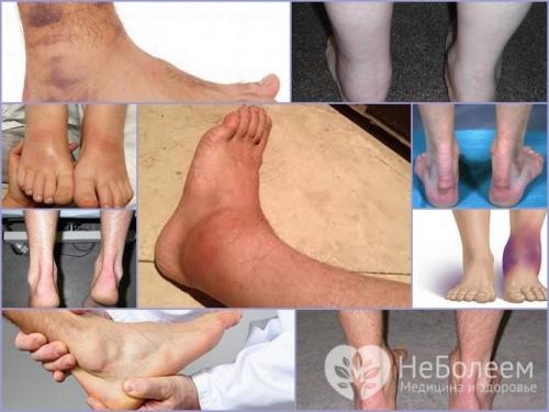 Голеностопный сустав отек. Почему опухает голеностопный сустав