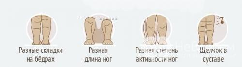 Дисплазия тазобедренного сустава у детей. Симптомы дисплазии тазобедренных суставов