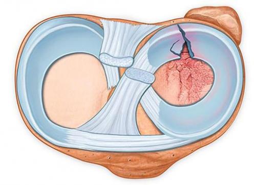 Повреждение медиального мениска коленного сустава симптомы и лечение. Что такое мениск коленного сустава, возможные повреждения, их причины и лечение