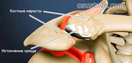 Ключично-акромиальное сочленение лечение. Акромиально-ключичный артроз плечевого сустава: симптомы и лечение