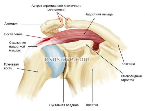 Ключично-акромиальное сочленение лечение. Акромиально-ключичный артроз плечевого сустава: симптомы и лечение