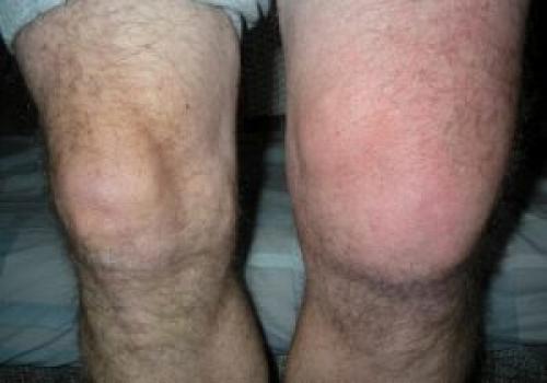 Где проходит нерв в колене. Защемление нерва в коленном суставе симптомы