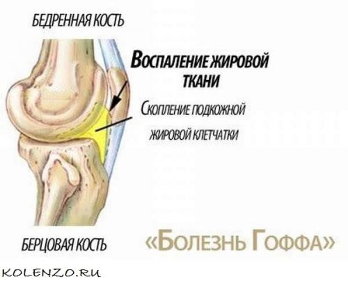 Ноющая боль в коленном суставе. Эффективные средства от боли в коленном суставе