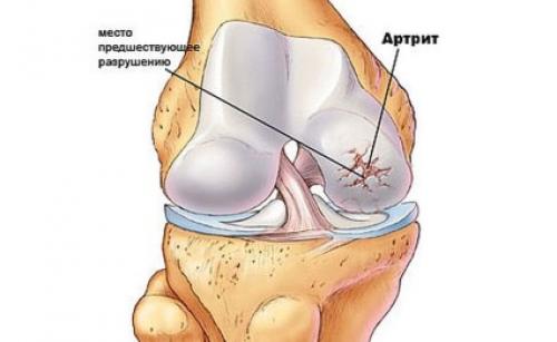 Артроз артрит коленного сустава мкб-10. Артроз и артрит по МКБ 10