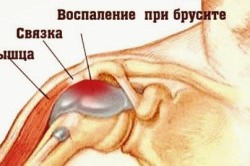 Хрустит лопатка. Причины возникновения заболевания