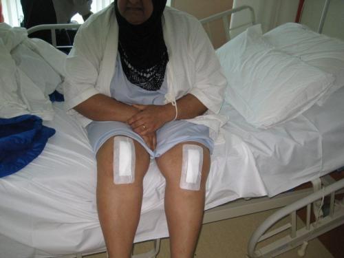 Операция на коленном суставе реабилитация. Замена коленного сустава, реабилитация после операции