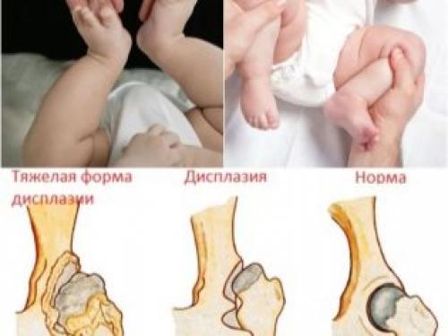 Дисплазия в 3 месяца. Лечение 04 Дисплазия в 3 месяца. Лечение 04