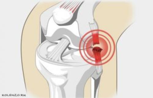 Ноющая боль в коленном суставе. Эффективные средства от боли в коленном суставе