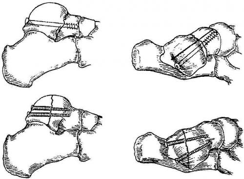 Асептический некроз блока таранной кости. Лечение некроза таранной кости голеностопного сустава в Москве 01
