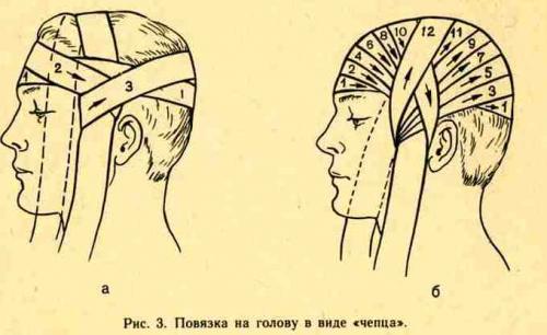 Чепец повязка. Техника наложения повязки \”Чепец\”