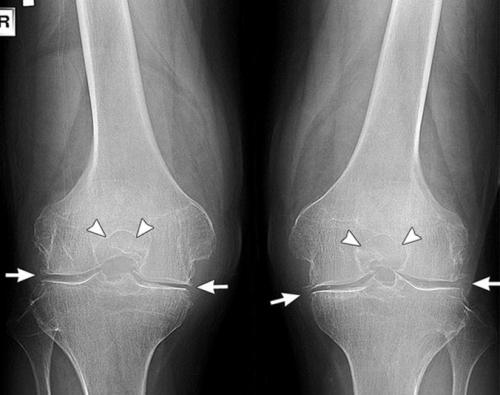 Артроз коленного сустава упражнения. Упражнения при артрозе колена, их виды, особенности выполнения и ожидаемые результаты от лечения