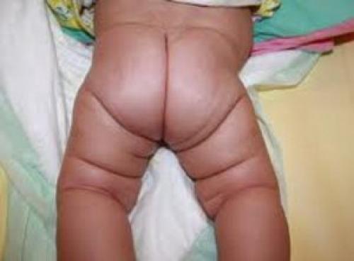 Углы тазобедренных суставов норма таблица. Угол тазобедренного сустава у новорожденного