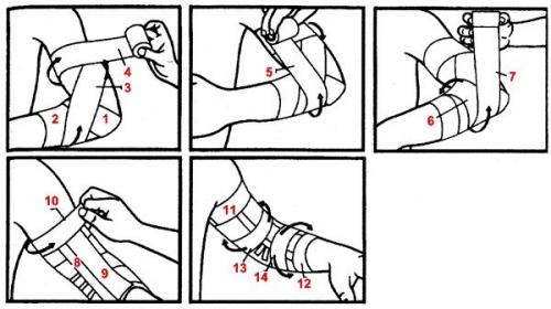 Черепашья сходящаяся и расходящаяся повязка на локтевой сустав. Техника наложения