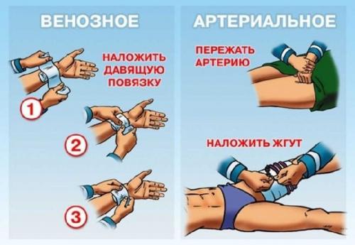 Черепашья сходящаяся и расходящаяся повязка на локтевой сустав. Техника наложения