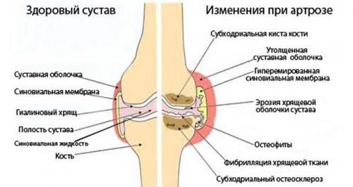 Опухли суставы пальцев рук лечение. Основные причины и методы лечения опухших суставов пальцев на руке