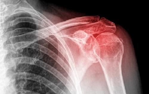 Если хрустит плечо, что делать. От чего появляется? 07 Если хрустит плечо, что делать. От чего появляется? 07