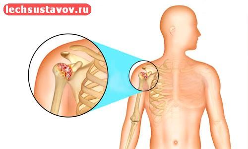 Остеоартроз плечевого сустава 2 степени. Остеоартроз плечевого сустава — лечение, симптомы, терапия, причины