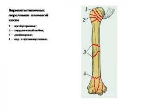 Восстановление подвижности плечевого сустава после перелома. 1 этап реабилитации — после наложения фиксирующей повязки